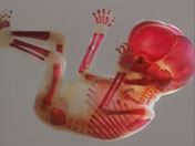 radioscopie d'un foetus
